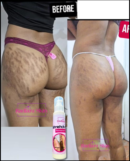 Crème anti-Vergeture Radiant⭐