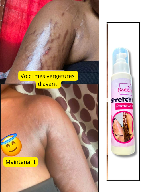 Crème anti-Vergeture Radiant⭐